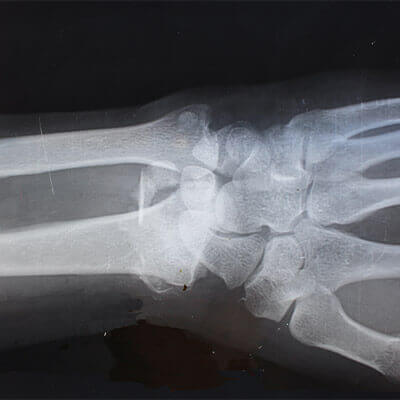 Undiagnosed or Missed Fracture Claims Solicitors